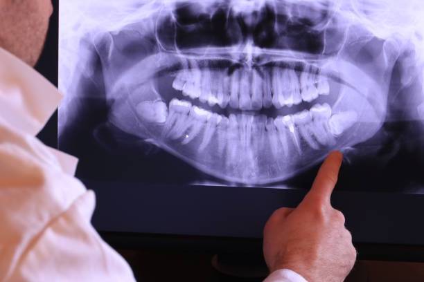 Best Broken or Cracked Tooth Emergency Dentist in Hudson Falls, NY